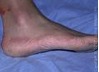 NY Foot and Ankle Clinic | Hammertoes, Diabetic Foot Care and Reconstructive Rear Foot Surgery