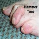 NY Foot and Ankle Clinic | Diabetic Foot Care, Ankle Arthroscopy and Ankle Foot Fractures and Sprains