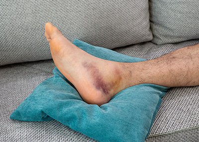 NY Foot and Ankle Clinic | Fractures of the Foot and Ankle, Corns and Poor Circulation