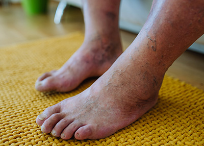 NY Foot and Ankle Clinic | Diabetic Foot Care, Cosmetic Foot Surgery and Hammertoes