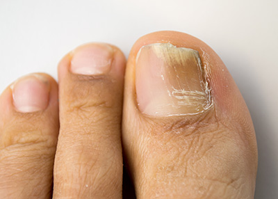NY Foot and Ankle Clinic | Reconstructive Rear Foot Surgery, Ankle Foot Fractures and Sprains and Wound Care