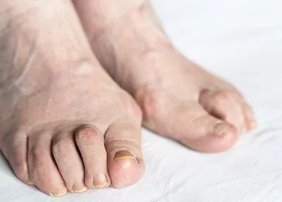 NY Foot and Ankle Clinic | Ankle/Foot Fractures and Sprains, Diabetic Foot Care and Bunions