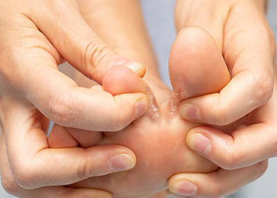 NY Foot and Ankle Clinic | Poor Circulation, Corns and Infections of Bone  Osteomyelitis  or Soft Tissue