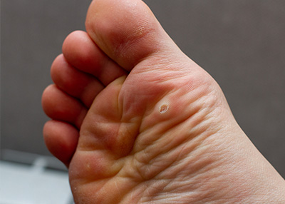 NY Foot and Ankle Clinic | Hammertoes, Brachymetatarsia and Reconstructive Rear Foot Surgery