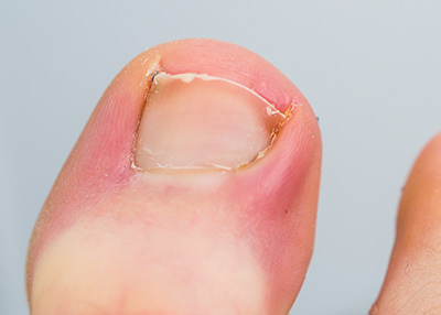 NY Foot and Ankle Clinic | Neuromas, Ankle Stability and Arthritic Foot   Ankle Care