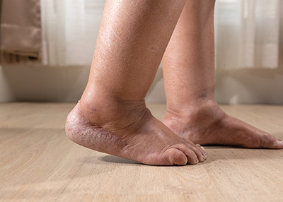 NY Foot and Ankle Clinic | Reconstructive Rear Foot Surgery, Diabetic Foot Care and Cosmetic Foot Surgery